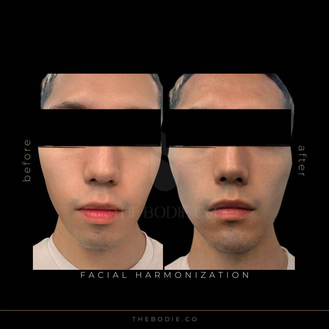 Facial Harmonization