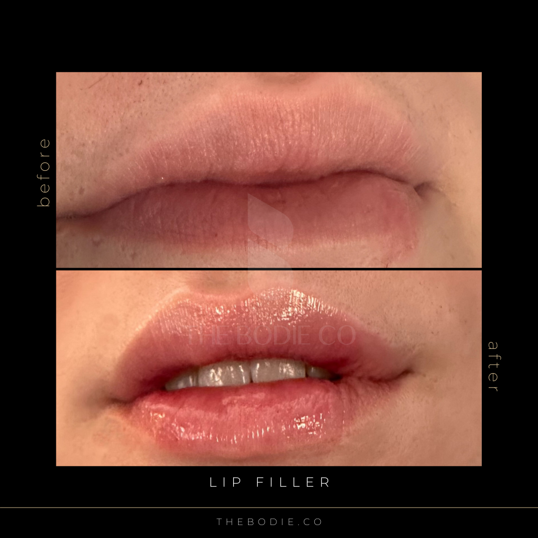 Lipfiller1