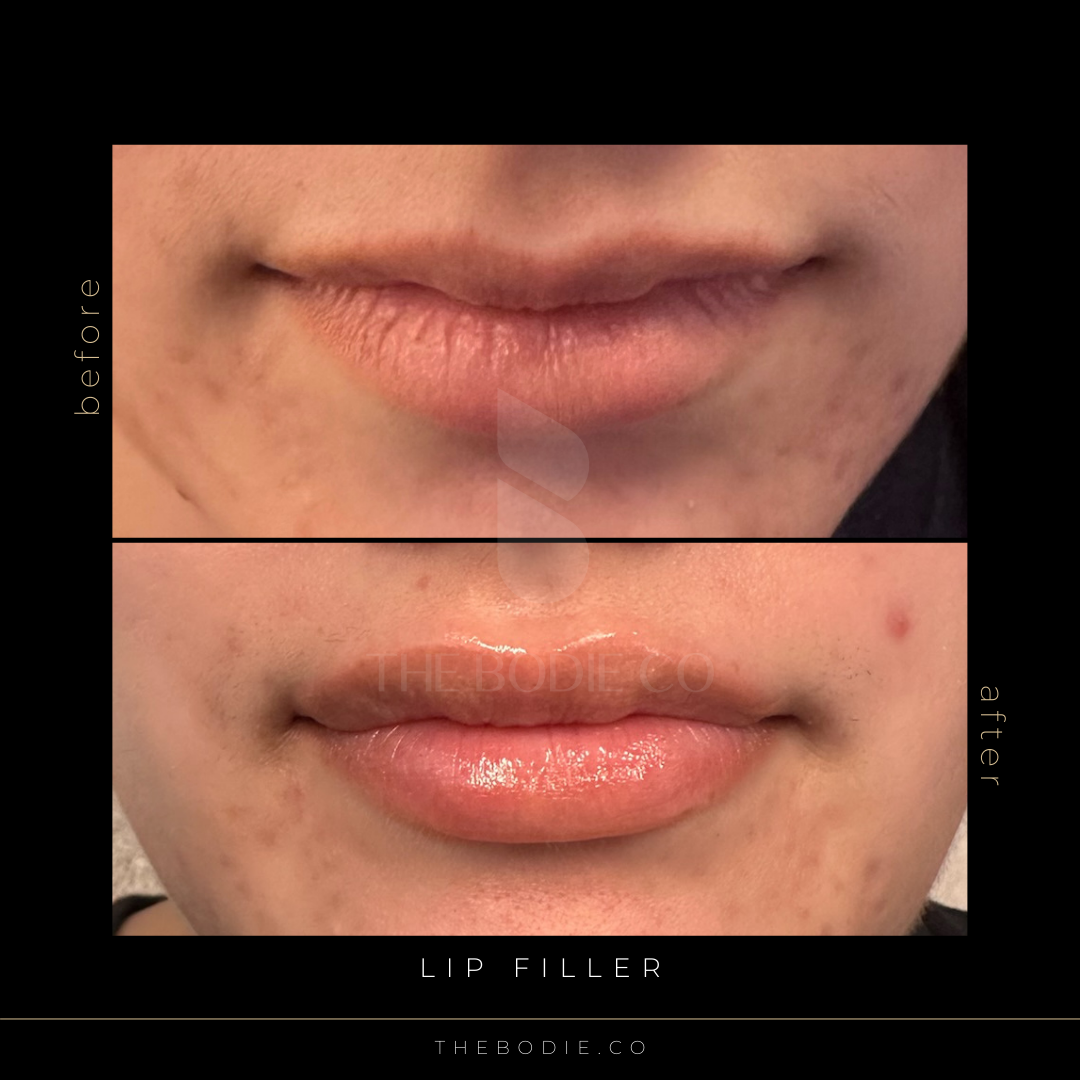 Lipfiller2